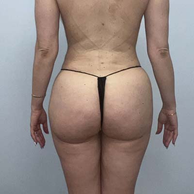Brazilian Butt Lift  Before & After Image